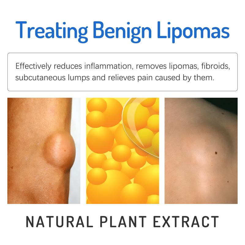 South Moon Lipoma Removal Cream, Relieve Fat Caking Tumor Subcutaneous Lumps Unclog Body Care