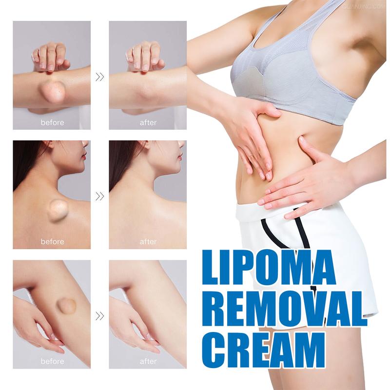 South Moon Lipoma Removal Cream, Relieve Fat Caking Tumor Subcutaneous Lumps Unclog Body Care