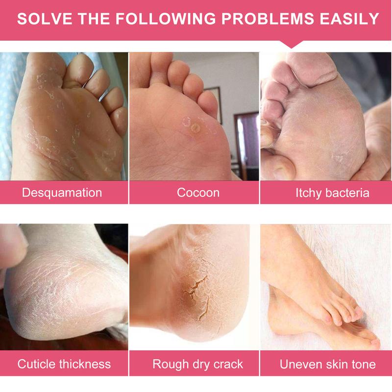 Aliver Foot Peel Mask, 5 Pack of Skin Exfoliating Foot Masks for Dry, Cracked Feet, Callus, Hydrating, Moisture & Silky (Rose Scent)