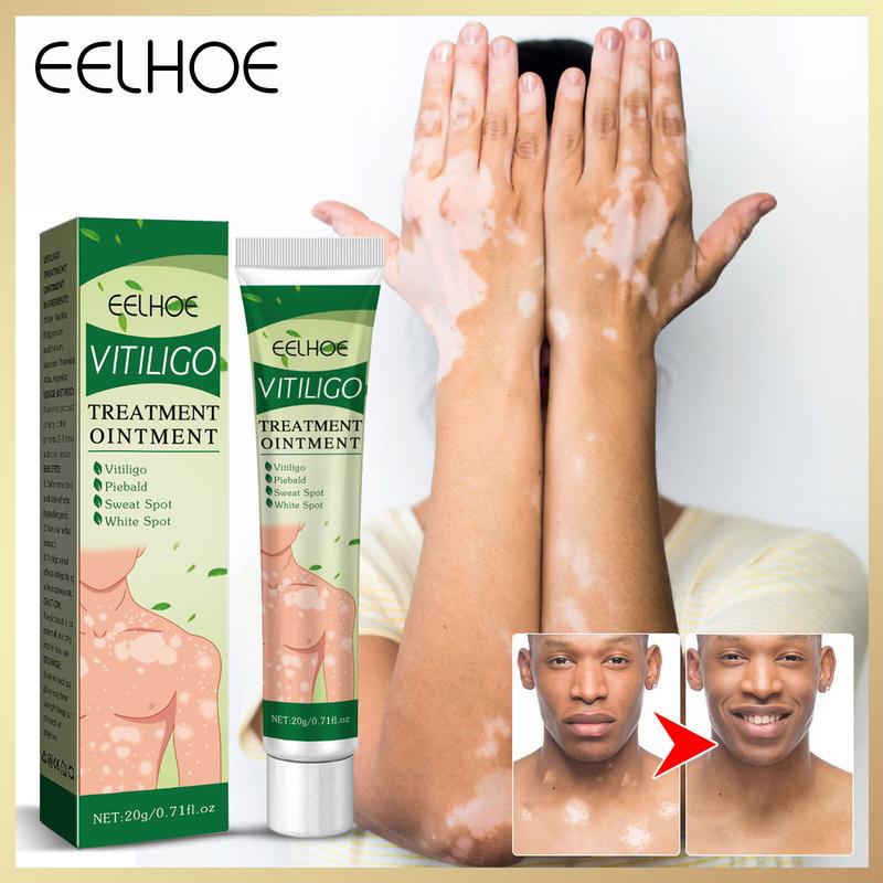 Eelhoe Vitiligo Treatment Ointment Remove Ringworm Sweat Spots Leukoplakia Disease White Spot Skin Repair Cream Psoriasis White Spot Repair Pigment Body Skin Care Cream（20g）