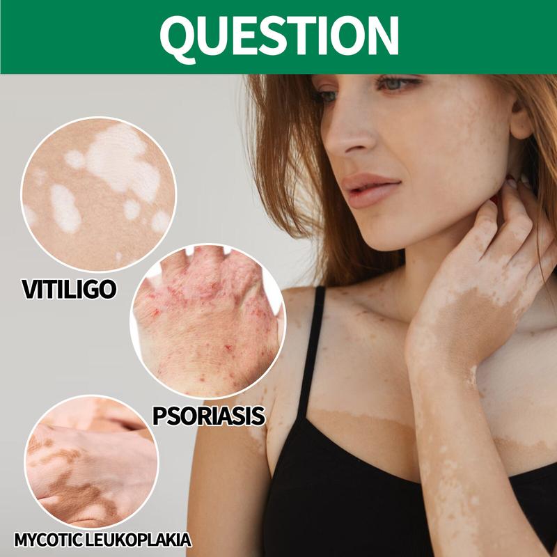 Eelhoe Vitiligo Treatment Ointment Remove Ringworm Sweat Spots Leukoplakia Disease White Spot Skin Repair Cream Psoriasis White Spot Repair Pigment Body Skin Care Cream（20g）