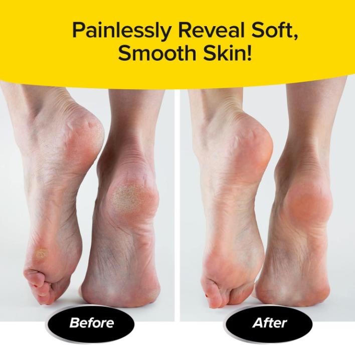 PedEgg Classic Callus Remover, As Seen On TV, New Look, Safely and Painlessly Remove Tough Calluses & Dry Skin to Reveal Smooth Soft Feet